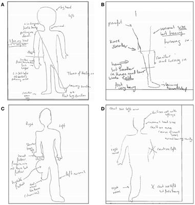 Bodily Sensory Inputs and Anomalous Bodily Experiences in Complex Regional Pain Syndrome: Evaluation of the Potential Effects of Sound Feedback